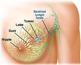 breast cancer diagram breasts