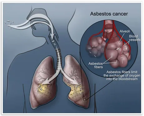 Photo Credit: mesothelioma.com